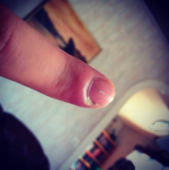 infekterat sår på fingret