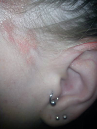 psoriasis bakom öronen