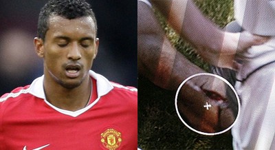 Haha! Detta är Nanis ben efter en tackling av Carragher (Mötet mellan Liverpool-United 6/3-11)    Bilden ser dock fejkad ut (?)