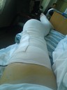 Mitt ben efter operationen. (Anledningen till bandaget är att jag inte ska bli svullen i benet. Ärret är från låret ner till strax under knät. 