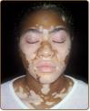 vitiligo3