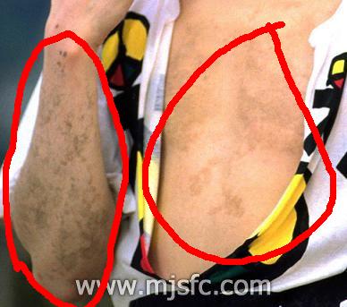 michael med vitiligo 2