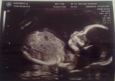 Here is a picture on the latest Ultrasound we had at 19+5 weeks, and we found out that we are having a little son =)