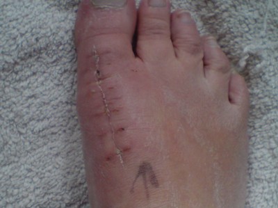 Så skönt att bli av med bandage och annat som satt fast på foten, men kan ännu inte ha vanliga skor!!så det blir att fortsätta med den 