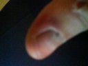 Inte så bra bild, men vi kan iaf se att nålen har gått igenom tummen ut i nageln